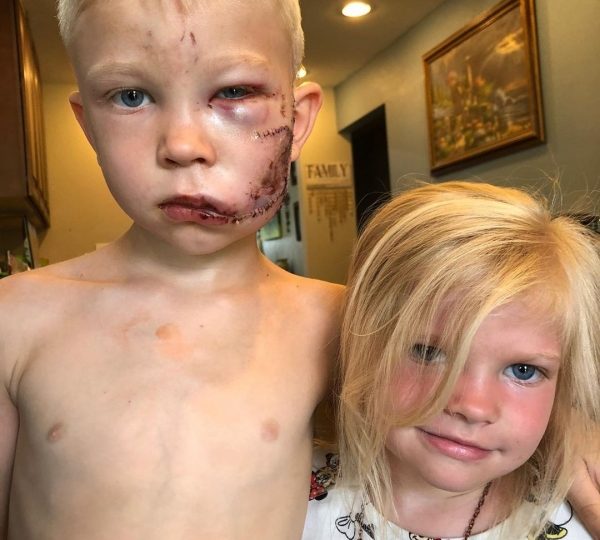 Super herói, menino de seis anos salva irmã ao se colocar entre ela e cachorro durante ataque nos EUA