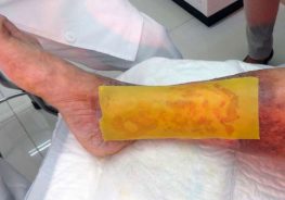 Adesivo de mel para diabéticos regenera pele em 21 dias: gratuito
