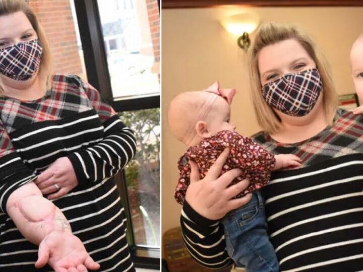 Médicos recolocaram o braço de mãe que sofreu acidente e ela pôde segurar seus bebês