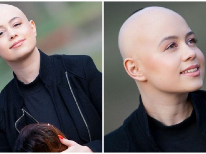 Jornalista desiste de perucas, aceita sua alopecia e convida as pessoas a se amarem como são