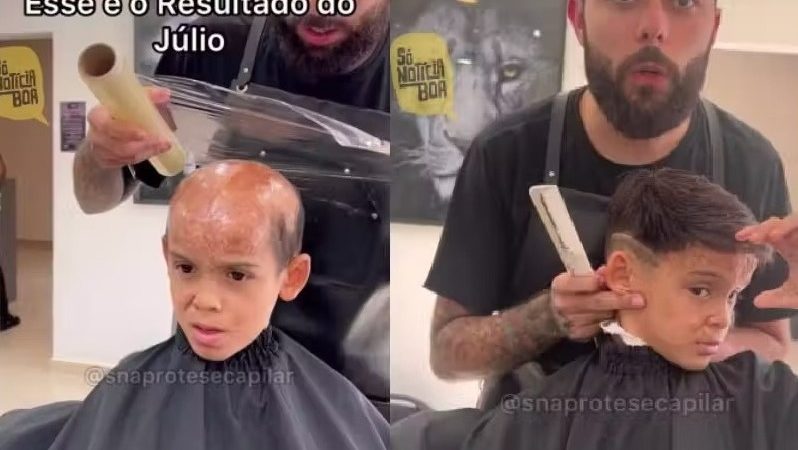 Estúdio dá prótese a menino com queimadura na cabeça. Veja a reação dele